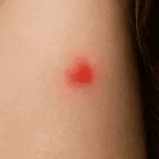 Τσίμπημα ψύλλου σε ανθρώπινο πόδι