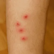 Τσιμπήματα ψύλλων σε άνθρωπο